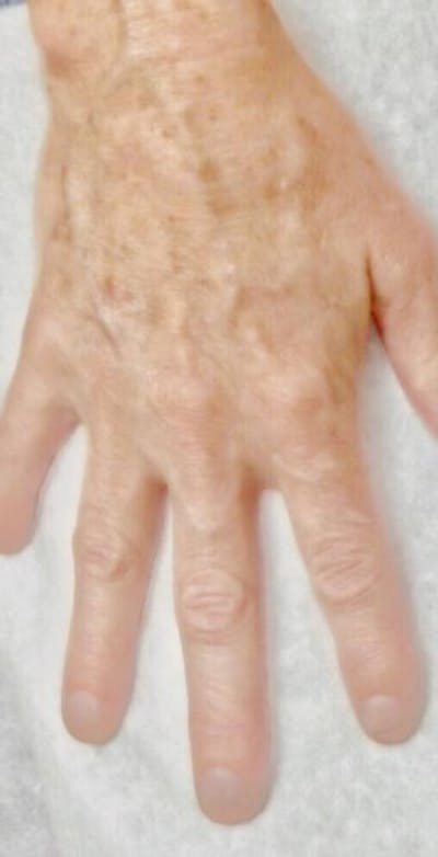 IPL Before & After Gallery - Patient 46621510 - Image 1