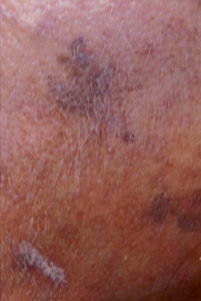 IPL Before & After Gallery - Patient 46621561 - Image 1