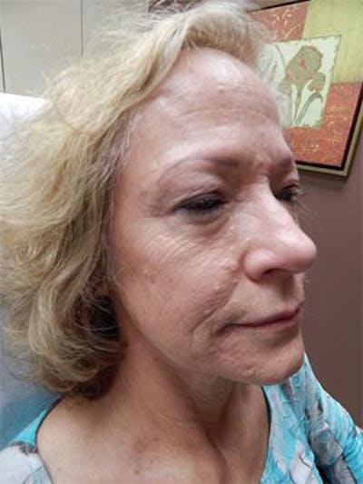 Vivace Microneedling Before & After Gallery - Patient 46628985 - Image 1