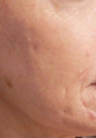 Vivace Microneedling Before & After Gallery - Patient 46628986 - Image 2