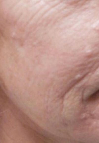 Vivace Microneedling Before & After Gallery - Patient 46628986 - Image 1