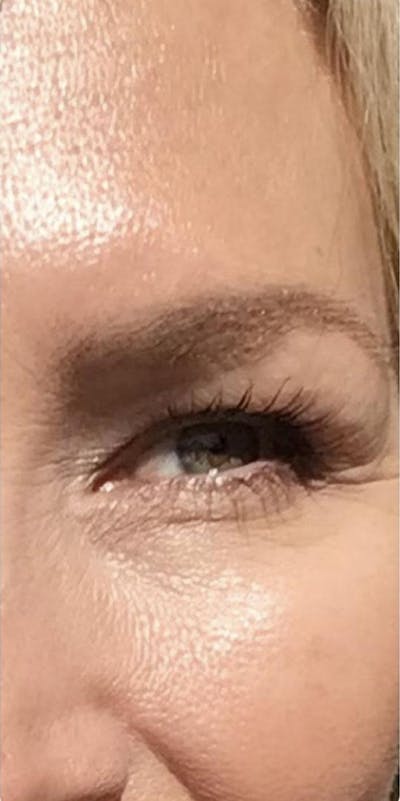 Botox Before & After Gallery - Patient 46619650 - Image 2