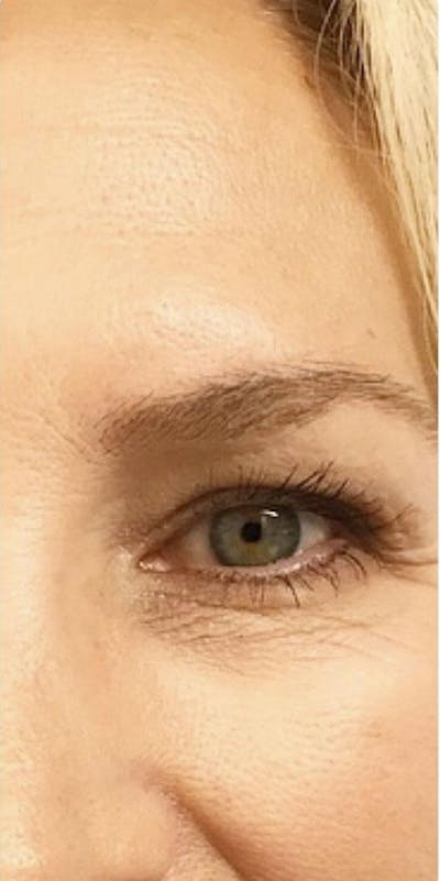 Botox Before & After Gallery - Patient 46619650 - Image 1