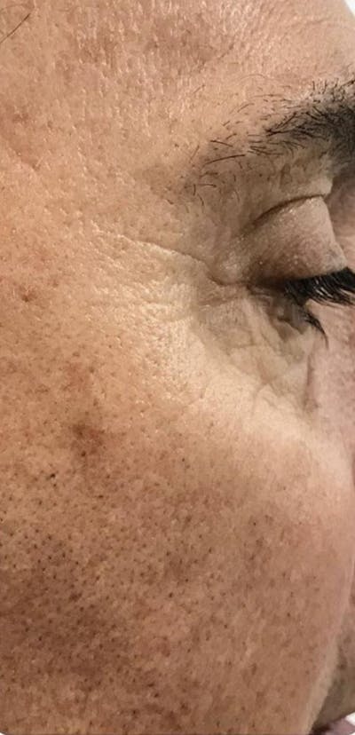 Botox Before & After Gallery - Patient 46619651 - Image 2