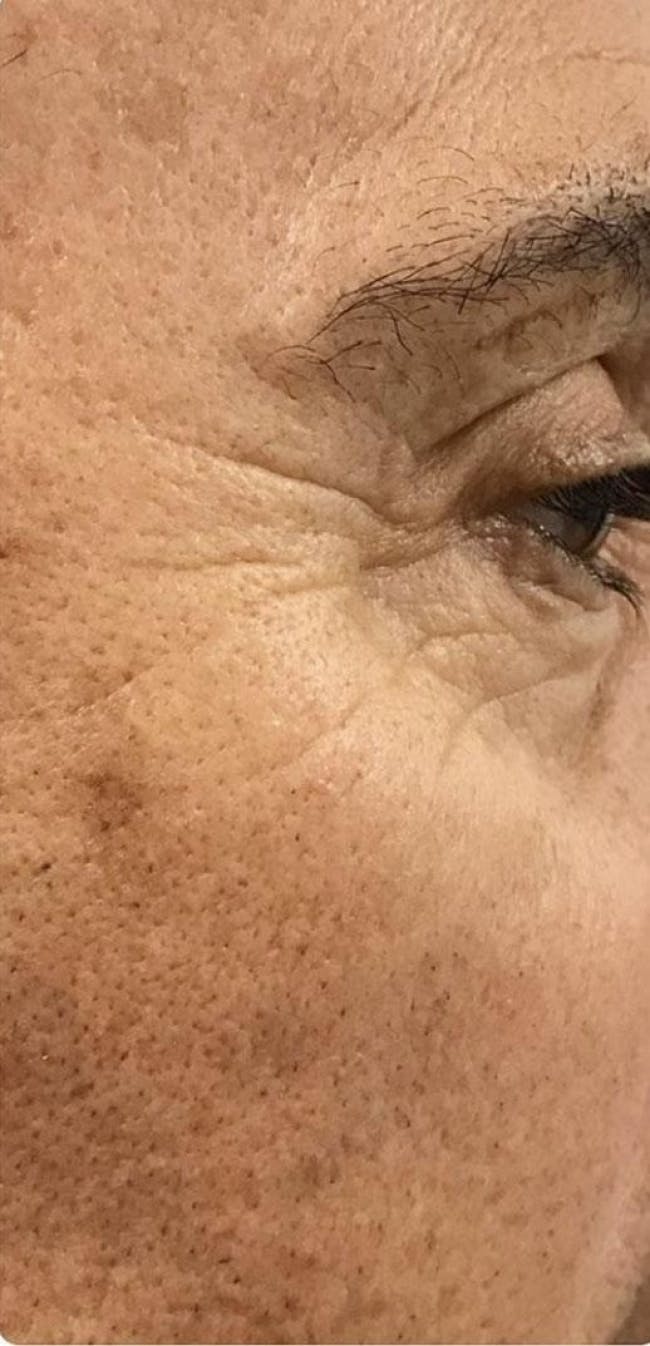 BOTOX