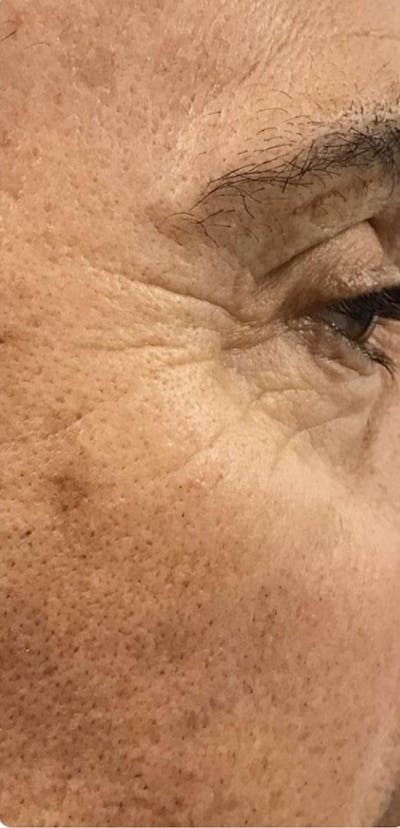 Botox Before & After Gallery - Patient 46619651 - Image 1