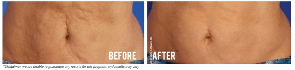 A before and after of a woman's abdomen