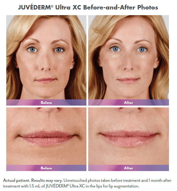 patient lip filler before and after