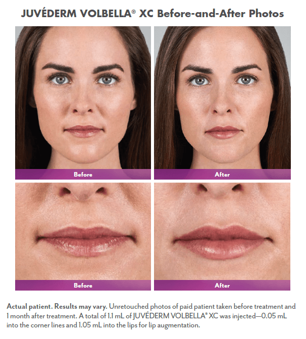 female brunette patient before and after lip fillers