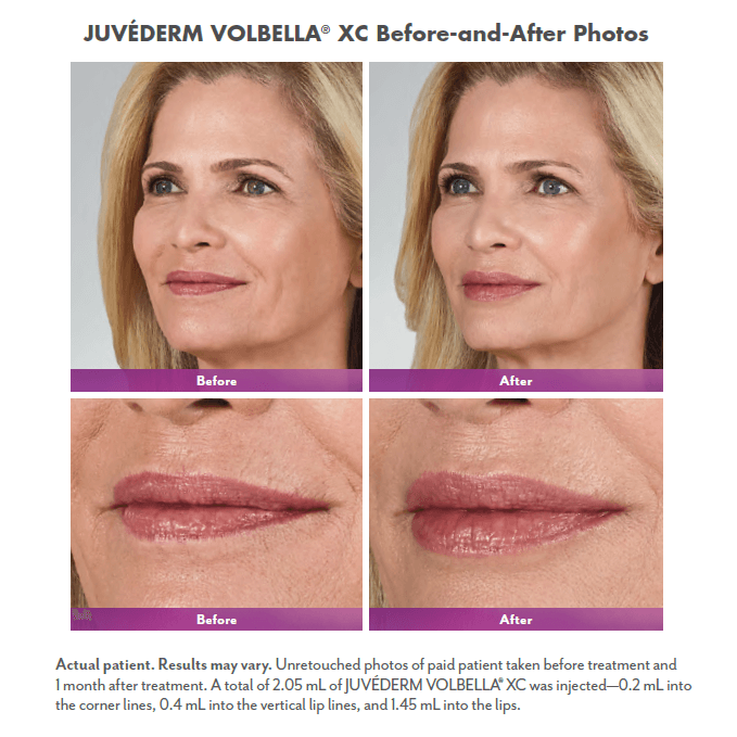 female blonde patient before and after lip fillers