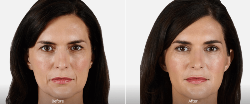 female brunette patient face before and after