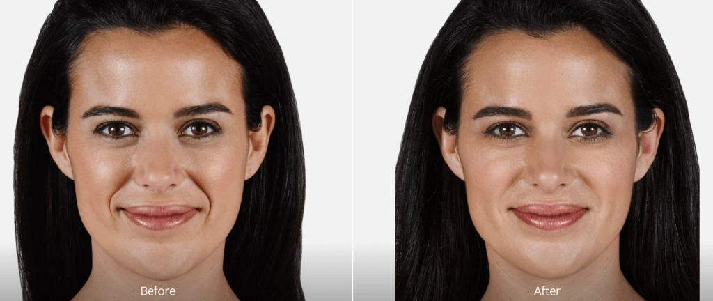 smiling brunette patient face before and after