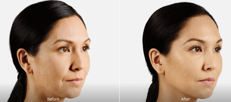 female black haired patient side profile before and after