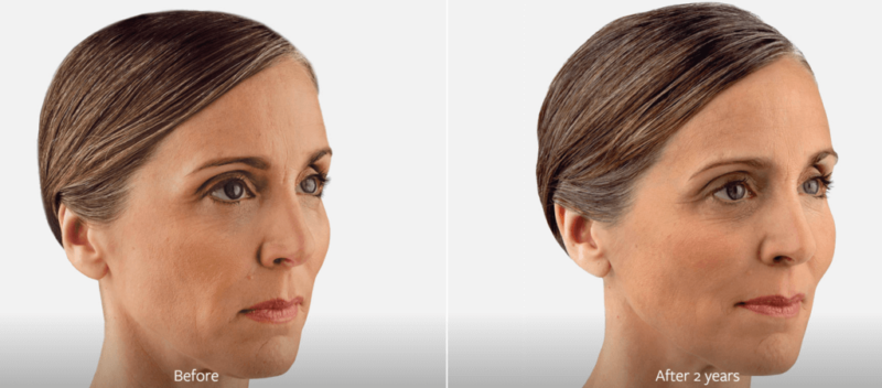 female brunette patient side profile before and after