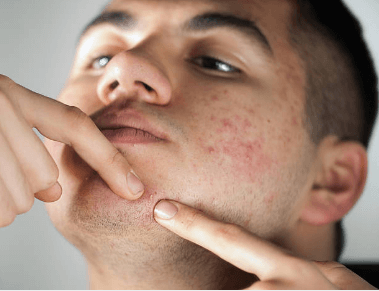 Acne Scar Removal Newport Beach Acne Scar Removal Newport Beach