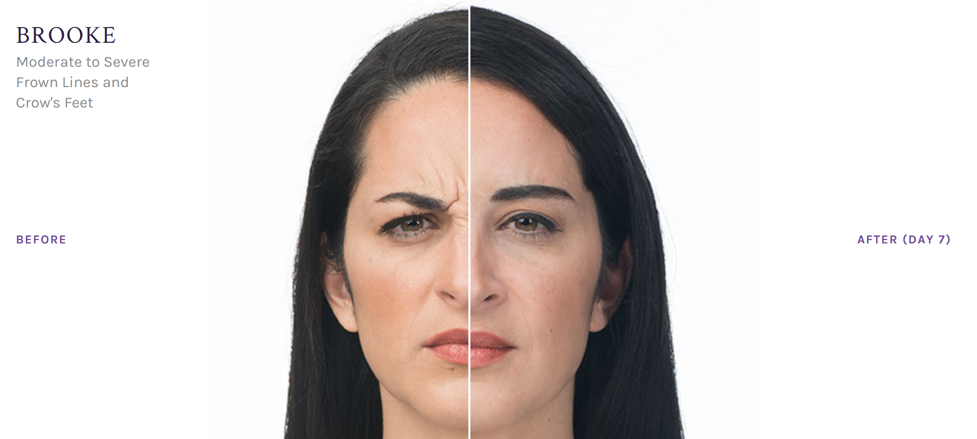 Botox Newport Beach & Rancho Santa Margarita Botox Newport Beach & Rancho Santa Margarita