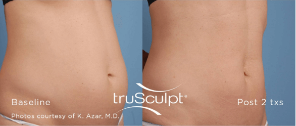 TruSculpt Rancho Santa Margarita