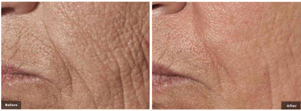 Wrinkle Pearl Fractional Laser Rancho Santa Margarita & Newport Beach