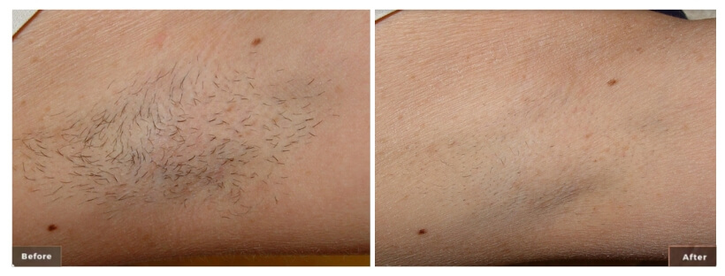 Laser Hair Removal Before & After Rancho Santa Margarita & Newport Beach