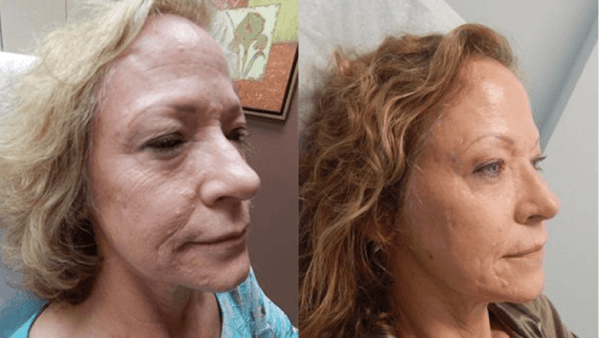 Microneedling with PRP Rancho Santa Margarita