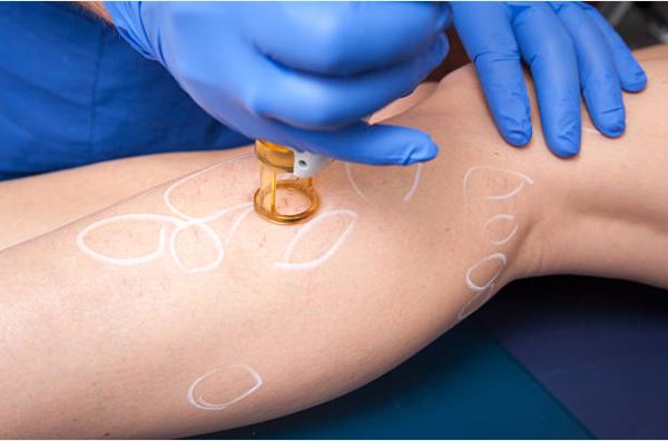 Laser vein removal Rancho Santa Margarita