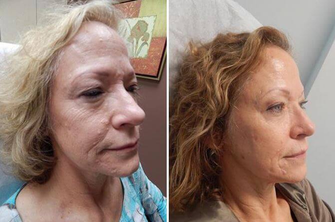 patient before and after her microneedling session