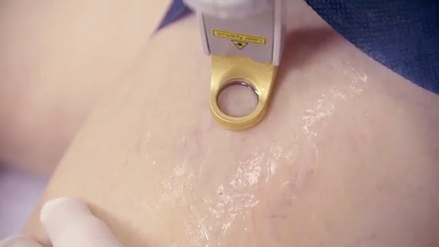 close up image of the laser resting on the skin of a patient