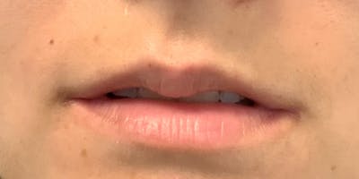 Lip Filler Before & After Gallery - Patient 54031019 - Image 1