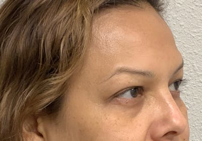 Botox Before & After Gallery - Patient 54692399 - Image 1