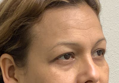 Botox Before & After Gallery - Patient 54692399 - Image 2