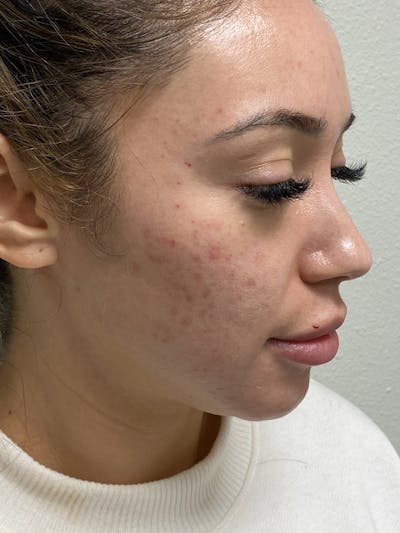 Botox Before & After Gallery - Patient 54692428 - Image 2