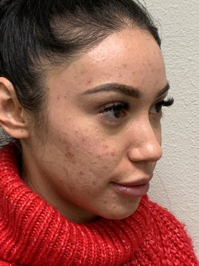 Botox Before & After Gallery - Patient 54692428 - Image 1