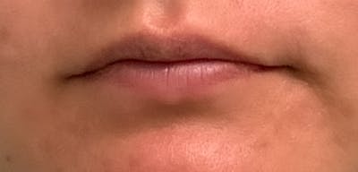 Lip Filler Before & After Gallery - Patient 54692445 - Image 1