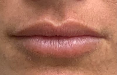 Lip Filler Before & After Gallery - Patient 54692505 - Image 1
