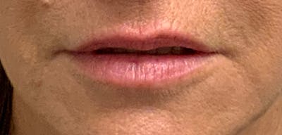 Lip Filler Before & After Gallery - Patient 54698022 - Image 1