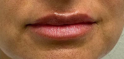 Lip Filler Before & After Gallery - Patient 54698052 - Image 1