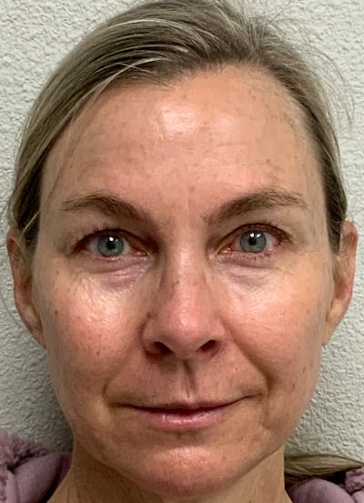 Botox Before & After Gallery - Patient 54698135 - Image 1