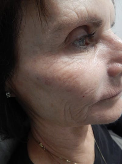 Vivace Microneedling Before & After Gallery - Patient 54698174 - Image 1