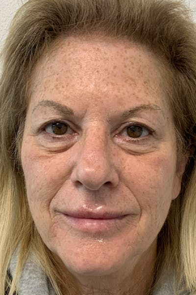 Vivace Microneedling Before & After Gallery - Patient 54698175 - Image 1