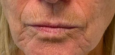 Lip Filler Before & After Gallery - Patient 54698178 - Image 1