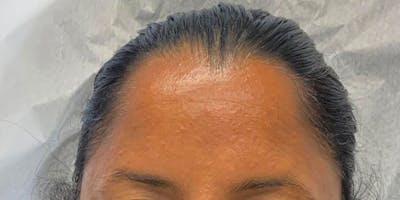 Botox Before & After Gallery - Patient 56157941 - Image 1