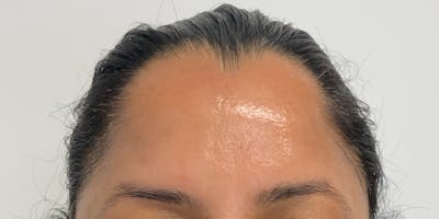 Botox Before & After Gallery - Patient 56157941 - Image 2