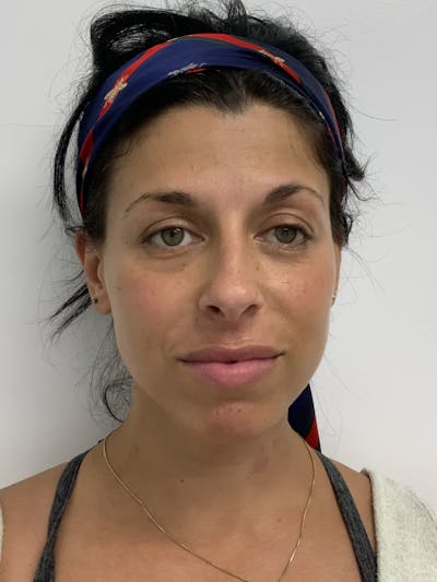 Botox Before & After Gallery - Patient 56158716 - Image 1