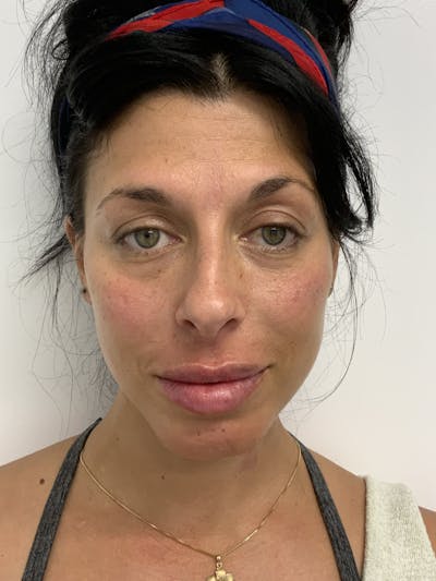 Botox Before & After Gallery - Patient 56158716 - Image 2