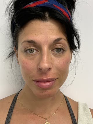 Dermal Fillers Before & After Gallery - Patient 56158465 - Image 2