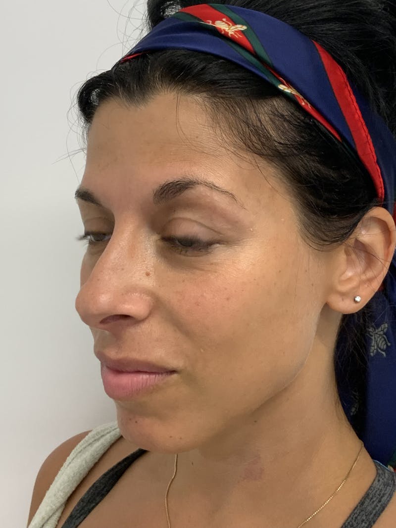 Dermal Fillers Before & After Gallery - Patient 56158465 - Image 3
