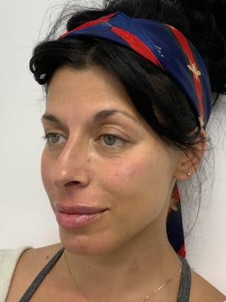 Dermal Fillers Before & After Gallery - Patient 56158465 - Image 4