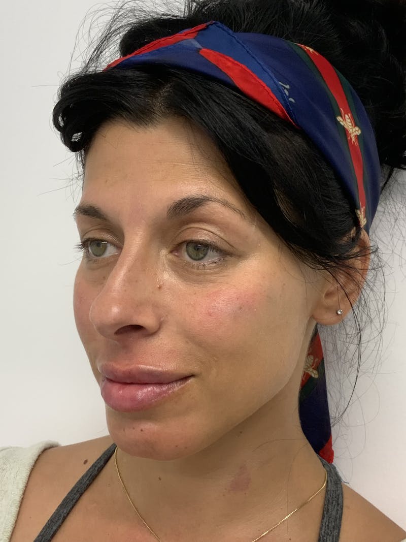 Dermal Fillers Before & After Gallery - Patient 56158465 - Image 4