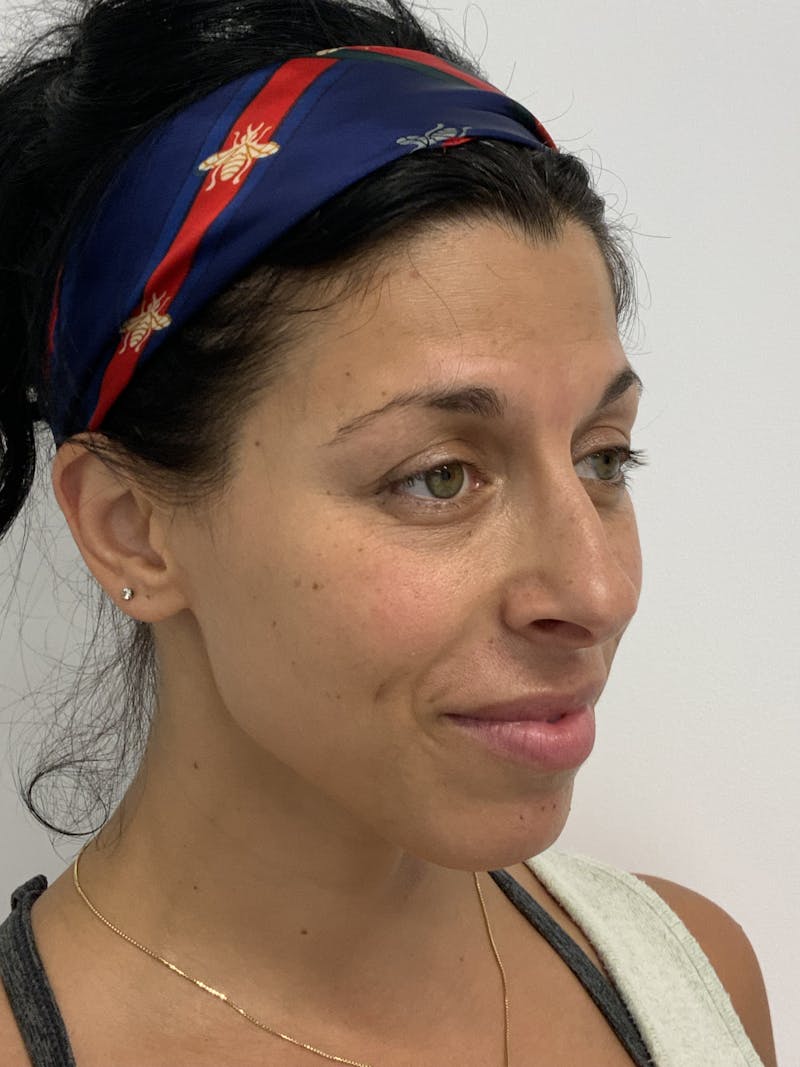 Dermal Fillers Before & After Gallery - Patient 56158465 - Image 5