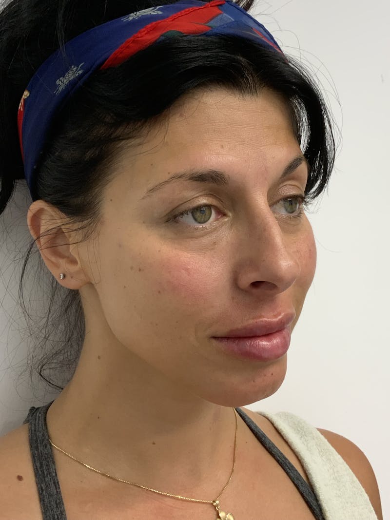 Dermal Fillers Before & After Gallery - Patient 56158465 - Image 6